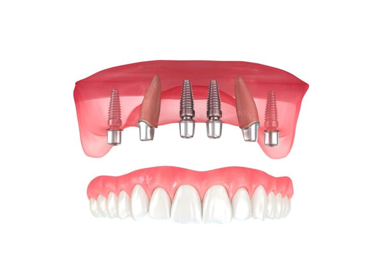 Implant Revolution: Elevating Oral Health Beyond Dentures